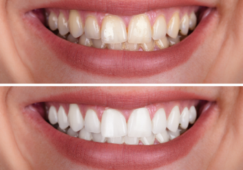 teeth whitening 3