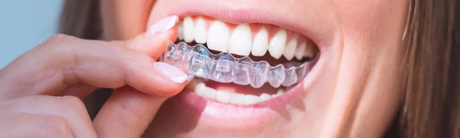 invisalign_img_2