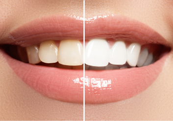 teeth whitening 3